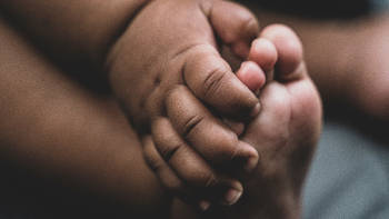 Clubfoot