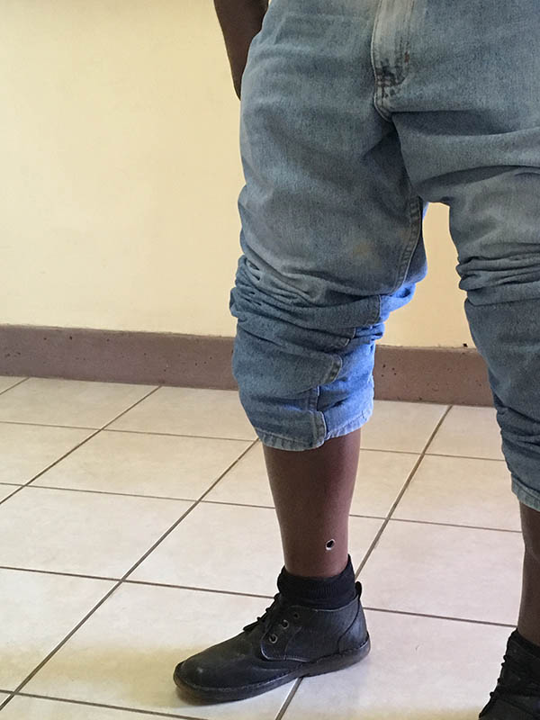 Prosthetic limb